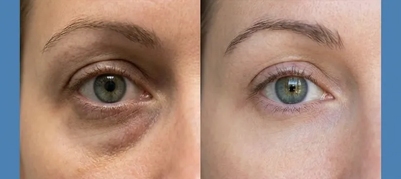 Dr. Melasmin Calcium Balm under-eye appearance comparison